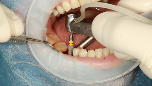 Implantes dentales 