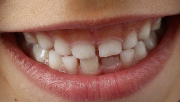 Curiosidades dentales II