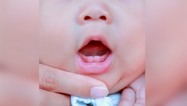 Dientes natales y neonatales