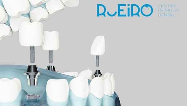 Implantes dentales I