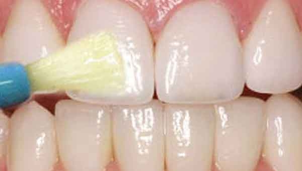 Barniz de Fluor