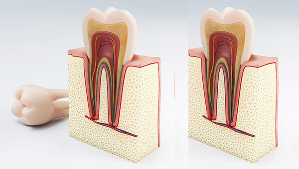 Dolor dental II