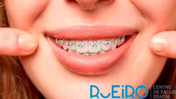 Ortodoncia invisible V