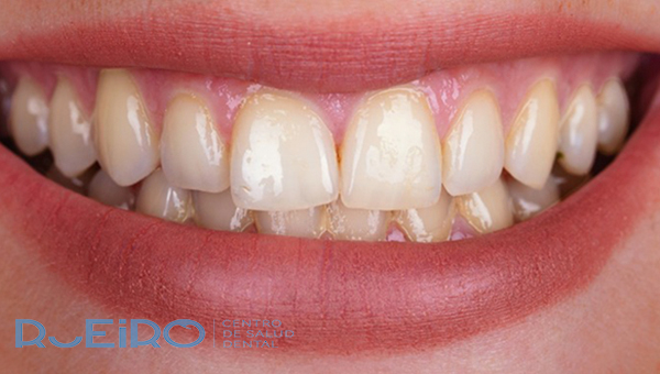 Tabaco y salud dental I 
